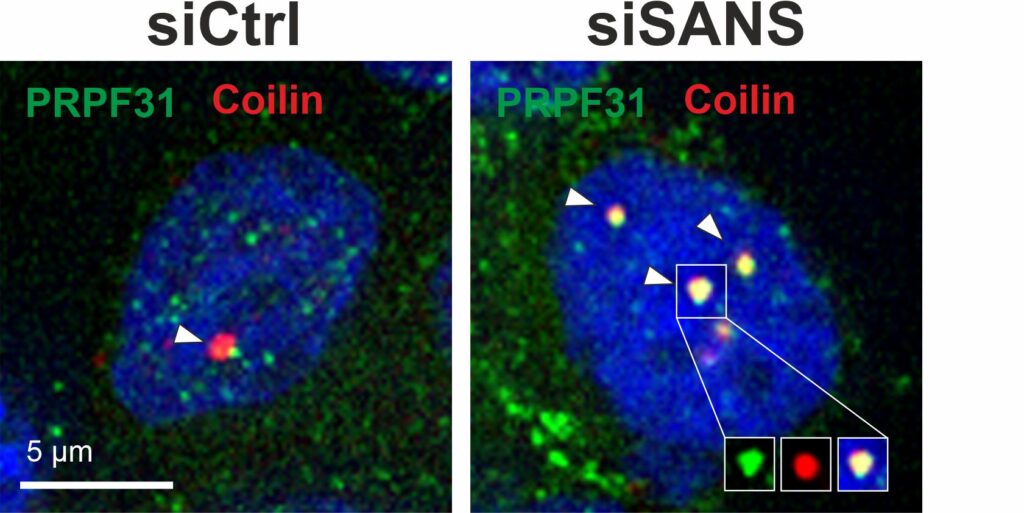 Bei Abwesenheit oder Herunterregulierung von SANS (siSANS) werden im Gegensatz zur Kontrolle (siCTRL) tri-snRNA-Komplexe nicht aus den Cajal-Körpern (Coilin, rot) entlassen und akkumulieren dort (tri-snRNA-Komponente PRPF31, grün). (Abb./©: Uwe Wolfrum, Adem Yildirim)